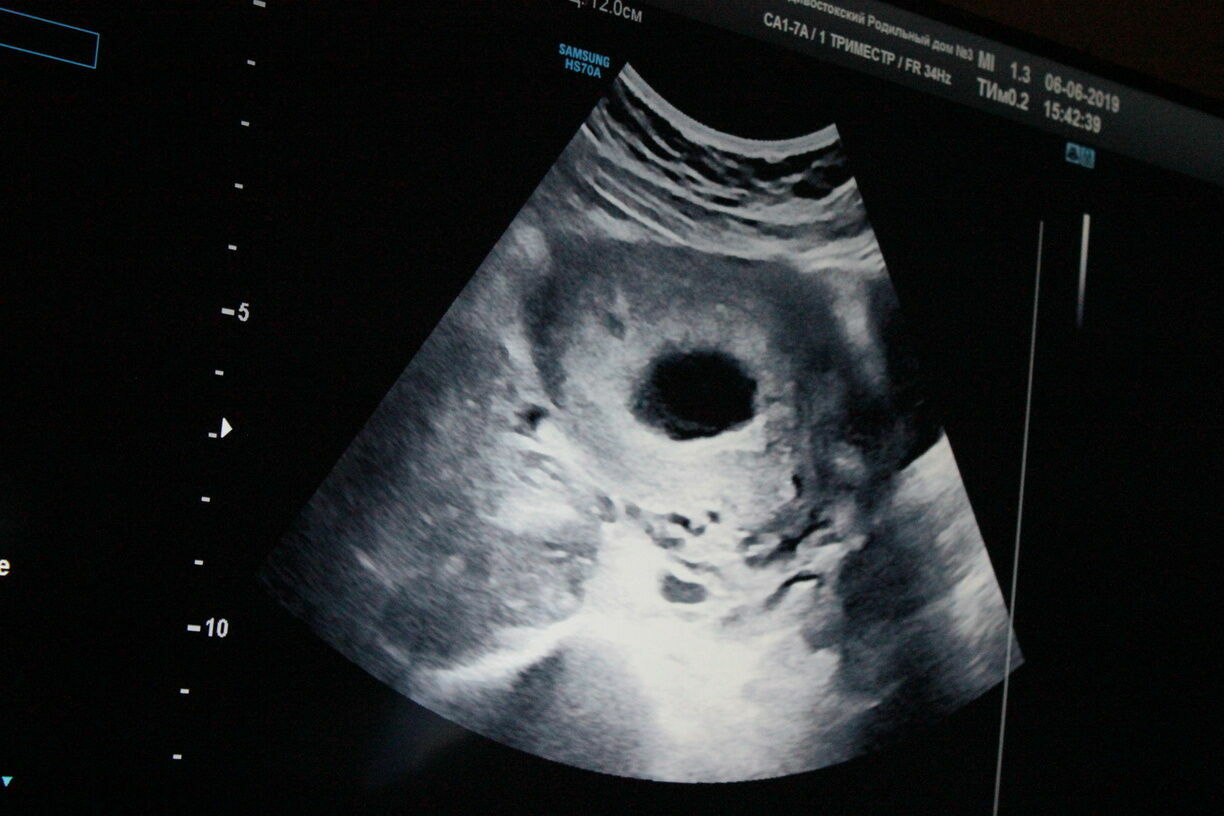 Беременная женщина, которую нашли у помойки в городе Карелии, родила